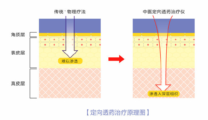 弘亿康中医定向透药治疗仪疗法对比