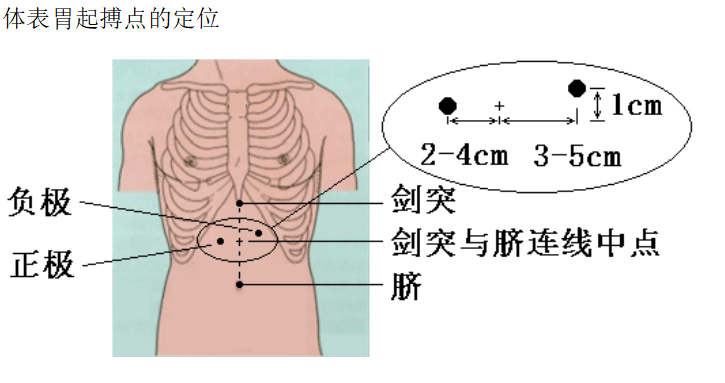 胃肠动力治疗仪起搏点定位